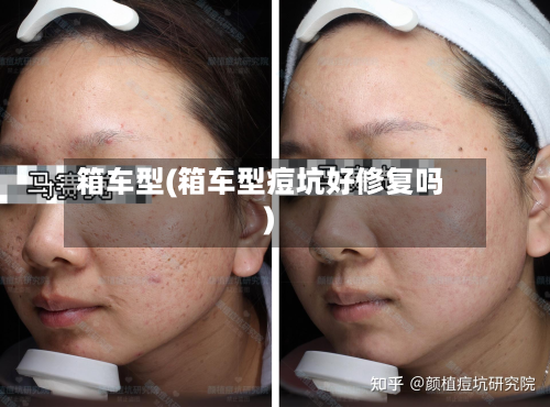 箱车型(箱车型痘坑好修复吗)-第2张图片